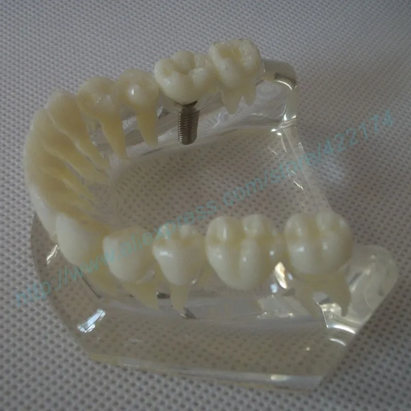 Implant model with bridge and caries 3