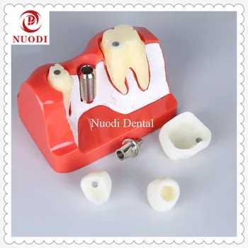 

Dental clinic Dental Implant Bridge Model Removeable bridge crown /4x Implant fixture teeth Model/Implant Education teeth model