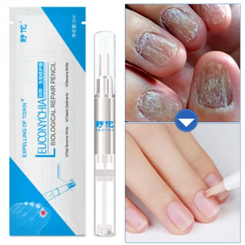

Nail Treatment Pen Onychomycosis Paronychia Anti Fungal Nail Infection Chinese Herbal Toe Traitement des champignons ongles @