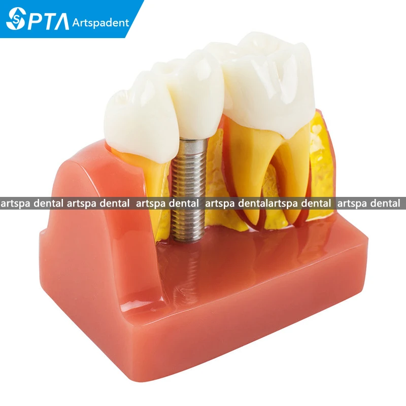 Модель имплантата коронного моста DEMOSTRATATION TEETH TOOH TYPODONT DENTOFORM