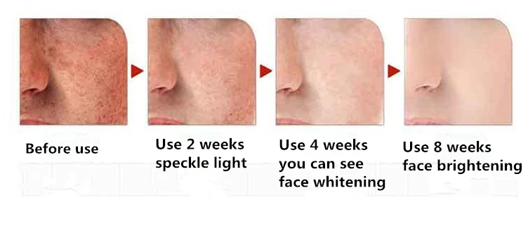 Dimollaure Bleaching Creme starke Wirkung 20g entfernt Sommersprossen ...