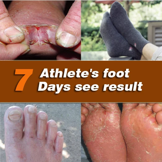 Anti Fungal Infections Foot Cream For Athlete's foot Treating Beriberi