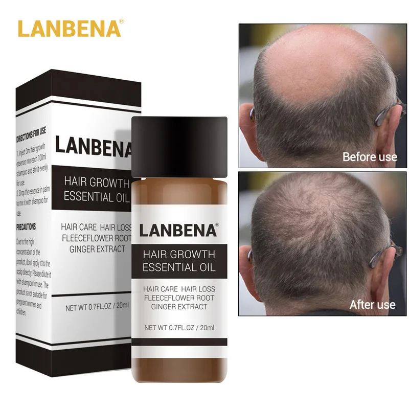 LANBENA экстракт имбиря эфирное масло для роста волос Предотвращение выпадения волос укрепляющее питающее Пробуждение волосяные луковицы жидкое средство для ухода 20 мл - Цвет: Essential Oil