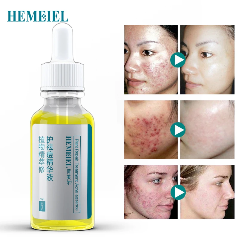 HEMEIEL Acne Scar Removal Face Serum Pimple Acne Treatment Plant Essence Oil Control Shrink Pores Facial Serum Skin Care 30ml HEMEIEL Acne Scar Removal Face Serum Pimple Acne Treatment Plant Essence Oil Control Shrink Pores Facial Serum Skin Care 30ml