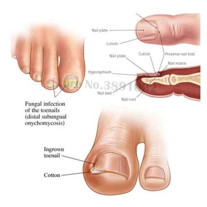 Травяное Лечение ногтей от грибка эссенция пальцев ног для ногтей противогрибковый Лечение ногтей удаление ногтей лосьон для ухода за ногтями