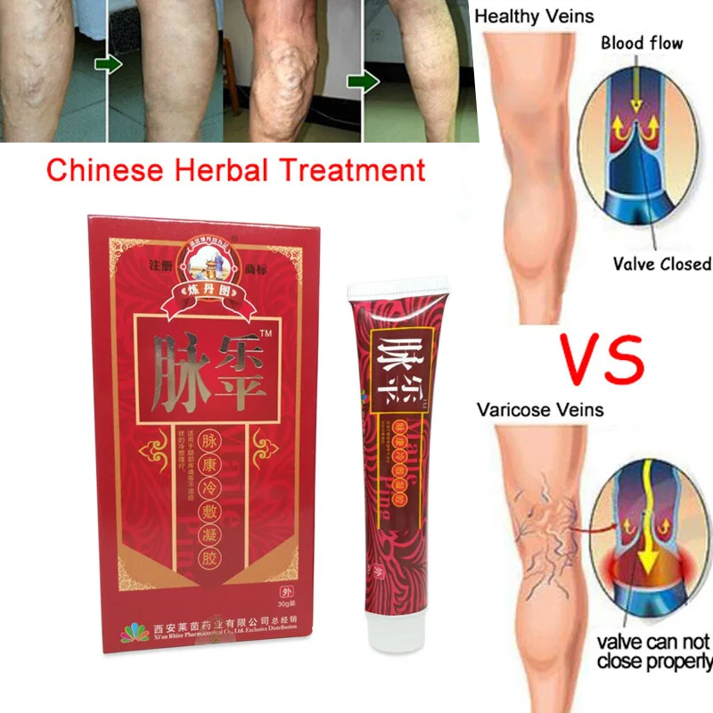 Varicose Veins Cream Relief Phlebitis Angiitis Inflammation Blood Vessel Health Care JIU55