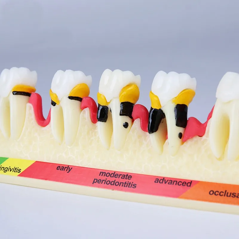 1 шт. стоматологическая модель зубов для пародонтологической зависимости и патологии зубов классификация M-4010