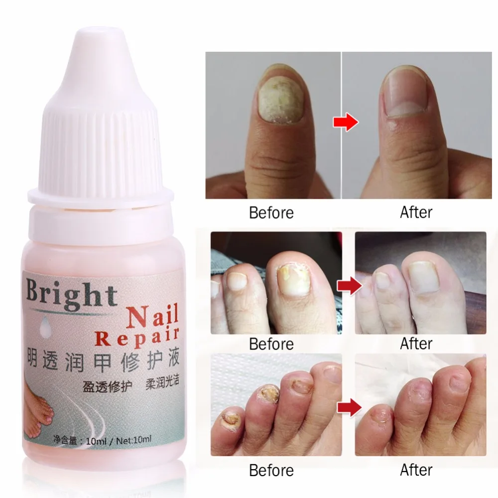 10ml Nail Fungal Treatment Essence Oil Toe Nail Fungus Removal Gel Anti