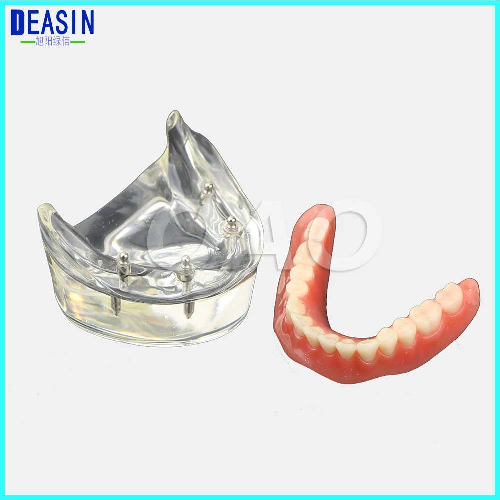 

Dental Teeth Study Model Overdenture Inferior 4 Implant Demo Model