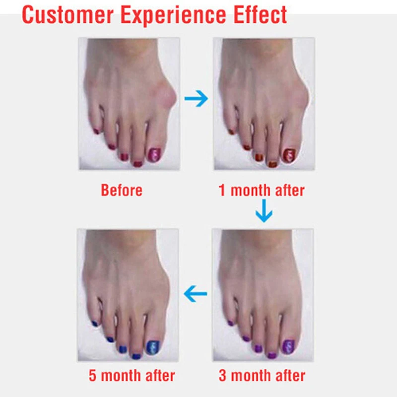 Sub-Toe Toe Braces Toe Separator Orthoses Thumb Big Feet Device Pad Foot Care Silica Gel Toes Separation Thumb Valgus Corrector