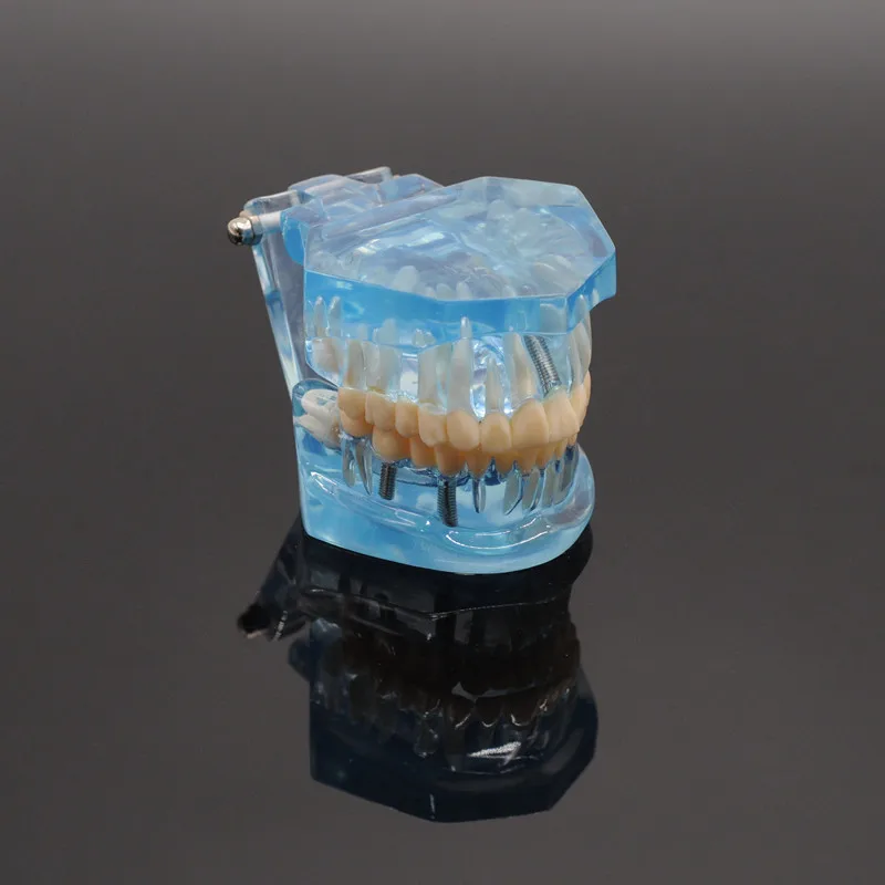 

Dental Study Tooth Model Adult Pathological Teaching Teeth Model Caries Dental Lab Clinic