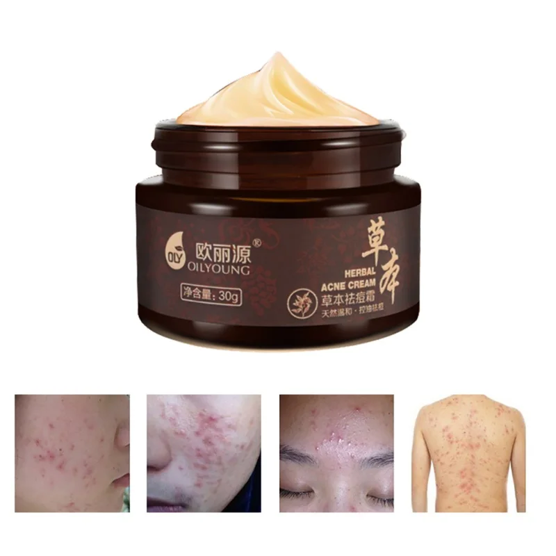 1 pc Herbal Anti-acne Cream Anti Pimple Spot Acne Scars Blackhead Removal Cream Whitening Beauty Skin Face Care Creams