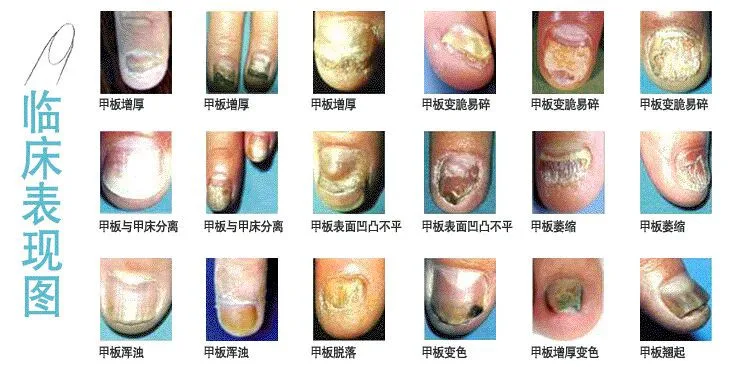 Chinese Medicine Herbs Toe Nail Fungus Treatment Anti Fungal Nail Infection Essence Nail Treatment Removal Nail Care Lotion