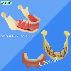 1 шт. челюсти имплантата зубы модель для обучения стоматолога лаборатория демонстрация