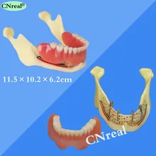 1 PC Mandible Implant Teeth Model for Dental Teaching Dentist Lab Demonstration 1 PC Mandible Implant Teeth Model for Dental Teaching Dentist Lab Demonstration