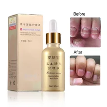 30 мл регенерация ногтей эфирное масло удаление грибка лечение онихомикоза RepairAnti инфекция Уход за ногтями лечение