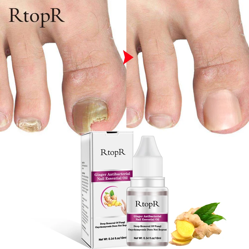 

RtopR 10ml Ginger Toe Nail Repair Treatment Essential Oil Remove Onychomycosis Antibacterial Nails Nourishing Nail Care TSLM1