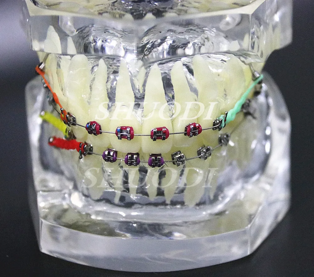 Прозрачная Стоматологическая Ортодонтическая модель мальлокклюзии с кронштейнами Archwire buccal пробки извлечения зуба для связи пациента