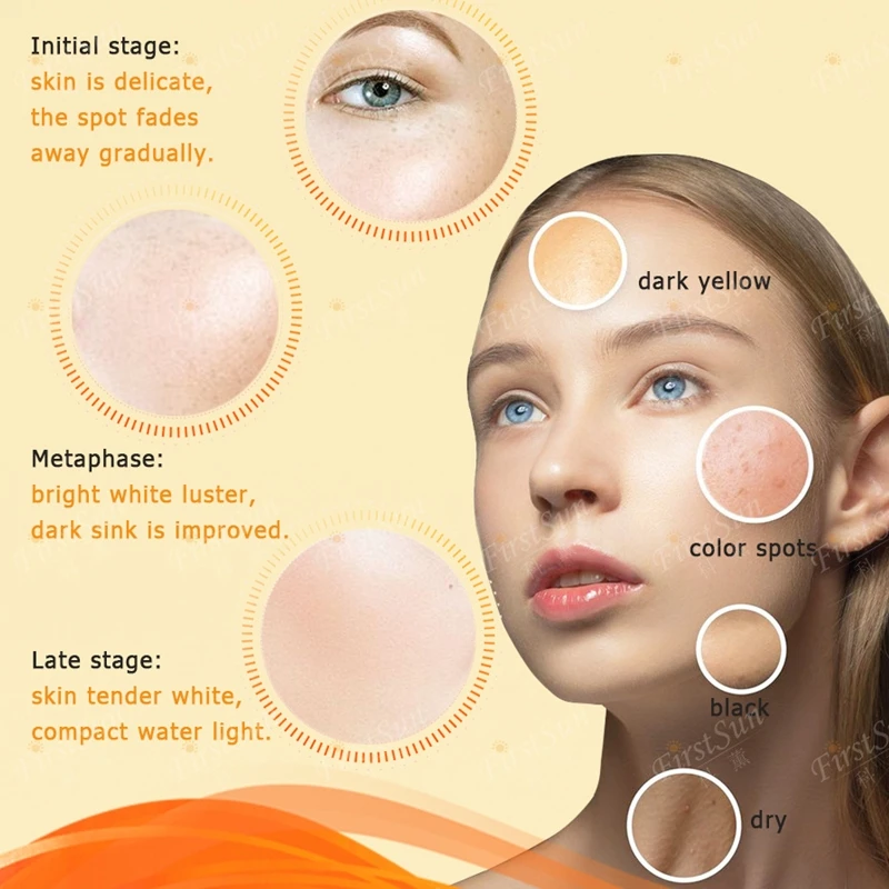 bleaching hyperpigmentation on face