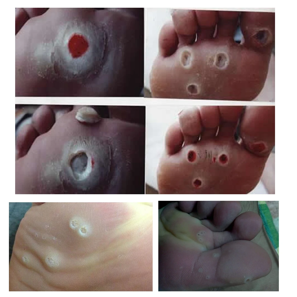 24 قطع القدم الذرة الجص إزالة مزيل الثآليل شوكة الجص الطبية الجص الرعاية الصحية ل تخفيف الألم النسيج الجص