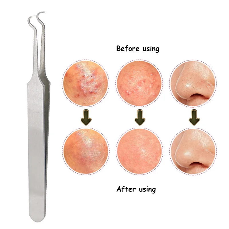 Buy 3Pcs Pimples Acne Needle Blackhead Remover Spot