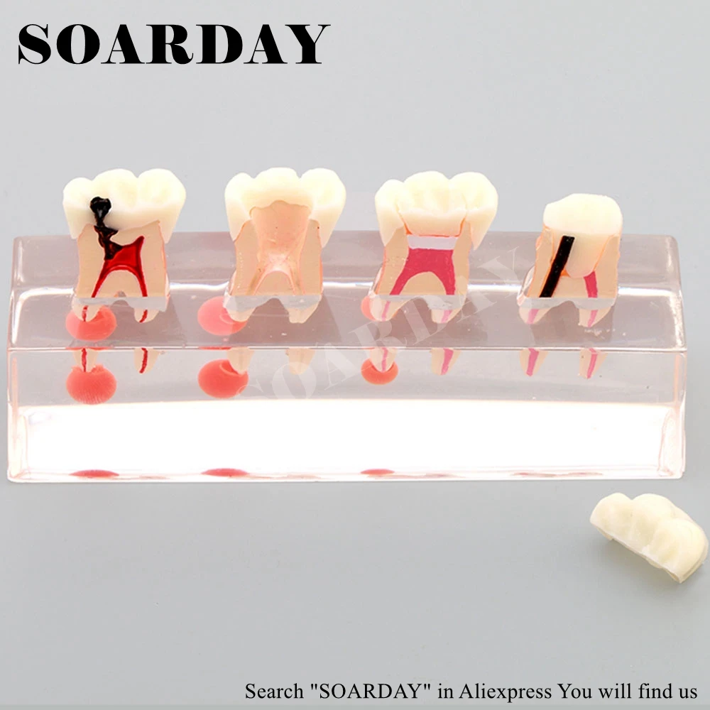 Dental Endodontic Restoration Model (5)