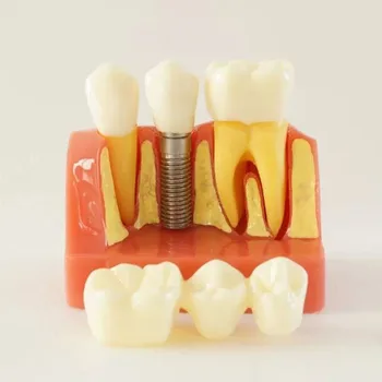 

Doctor patient communication 4 Times Dental Implant Model