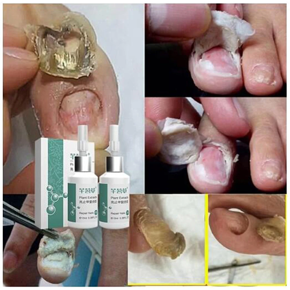55 г Лечение ногтей жидкое противогрибковое средство для ремонта ногтей яркий носок грибок Антибактериальная жидкость для лечения Ногтей