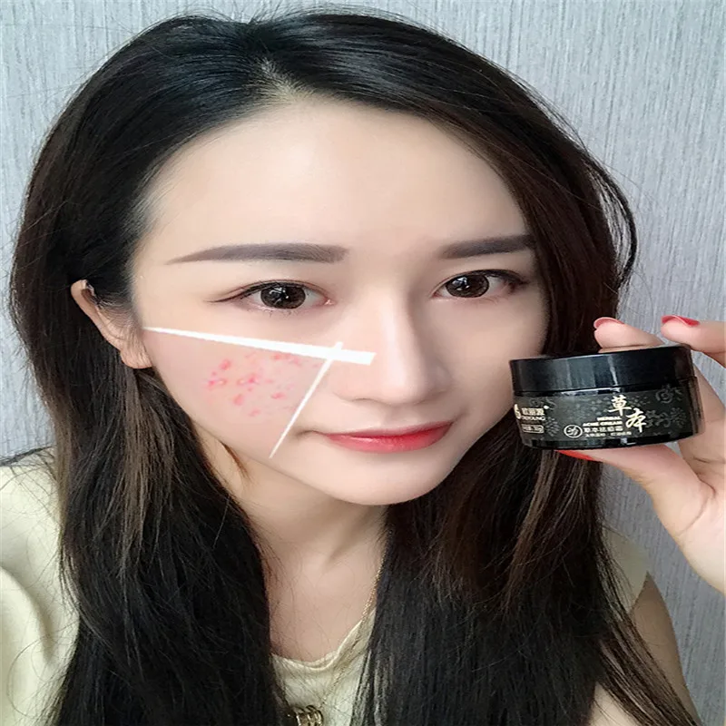 Oilyoung Acne дневной крем против прыщ место в горошек шрамы удаления Для лица