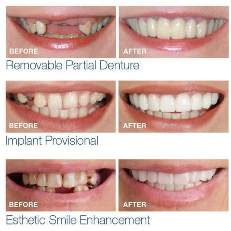 Drop-Ship-Smile-Maker-Fit-Flex-Teeth-with-Box-Fits-Snap-on-Smile-False-Teeth-Upper (1)