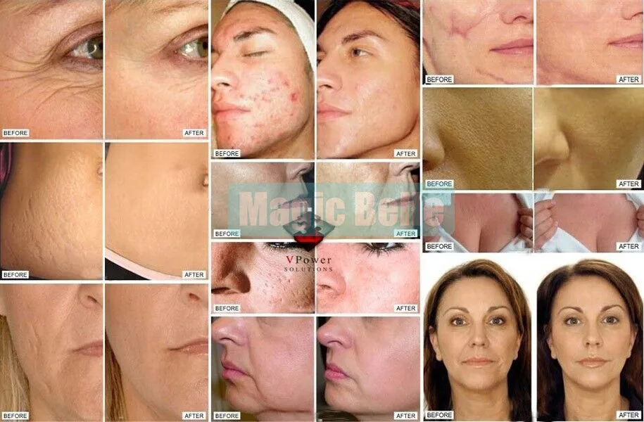 Luz para Rejuvenescimento da Pele Profissional Coreia Tecnologia Omega Tratar Acne 17 Utensílios de cuidado facial
