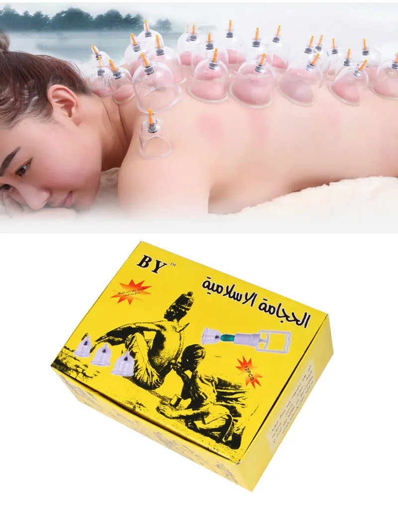 cupping (3)