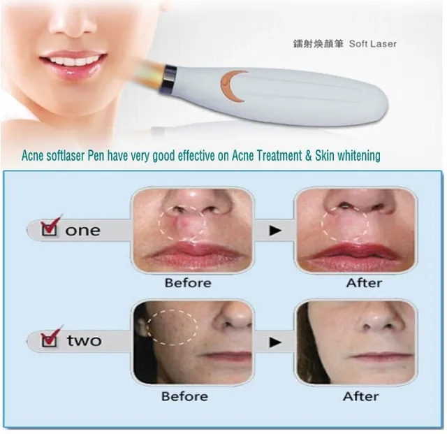 soft laser therapy review