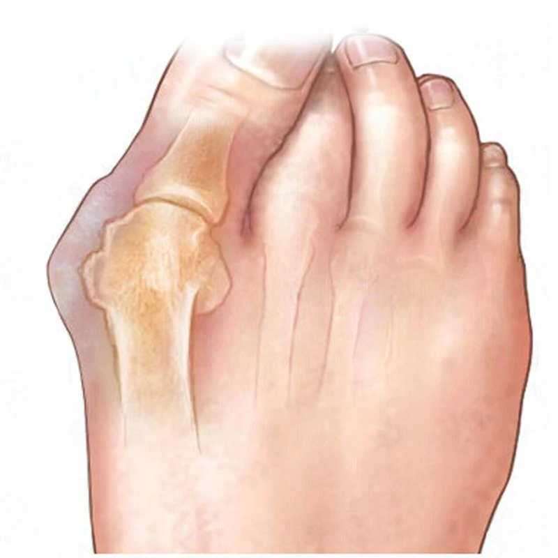 1 пара Hallux Valgus Корректор осанки палец ноги, наружный прибор Жук-дробилка Ectropion массаж ног силиконовый гель ног сепаратор