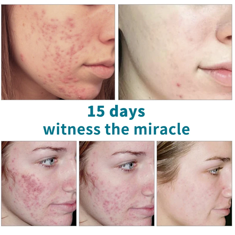 HEMEIEL Anti-Acne Serum Scar Removal Natural Essence Pimple Acne Treatment Repair Scars Facial Whitening Oil Control Skin Care