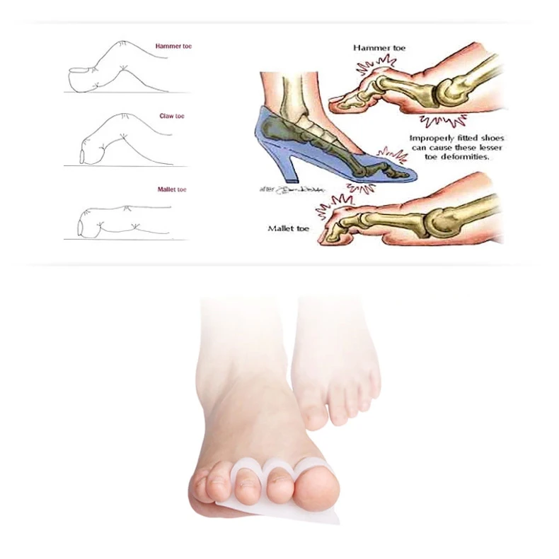 

3 Pairs Hallux valgus orthosis Toe overlap correction Hammertoe correction pad Beetle crusher bone hallux valgus Toe separator