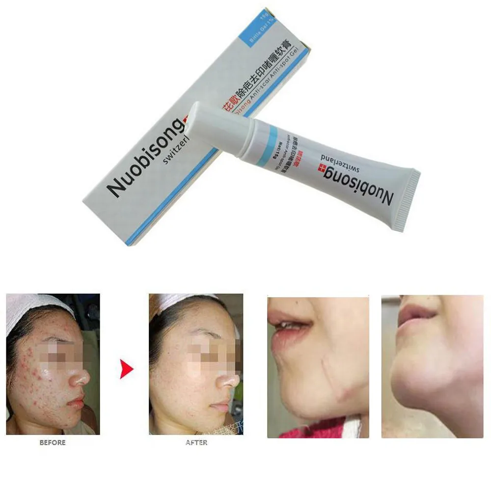 Китайский уход за кожей лица, крем для удаления прыщей, пятен, шрамов, растяжек, лечение