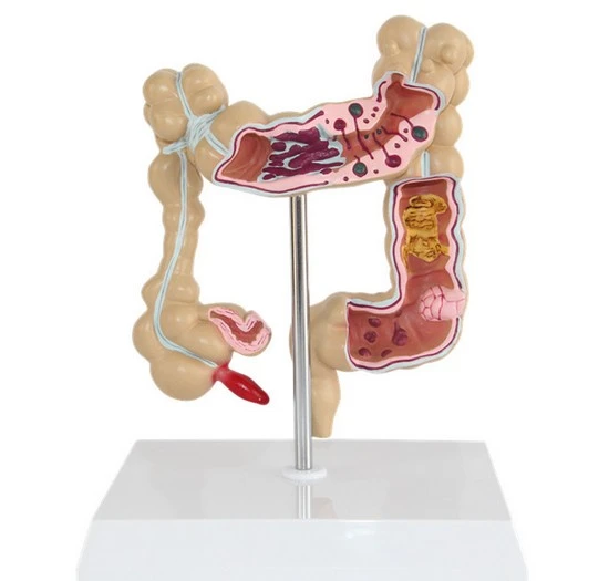Lehrmodell Der Medizinischen Menschlichen Modell Von Colon Pathologischen Modell Rektum Anhangen Medizinische Lehrmodell Colon Aliexpress