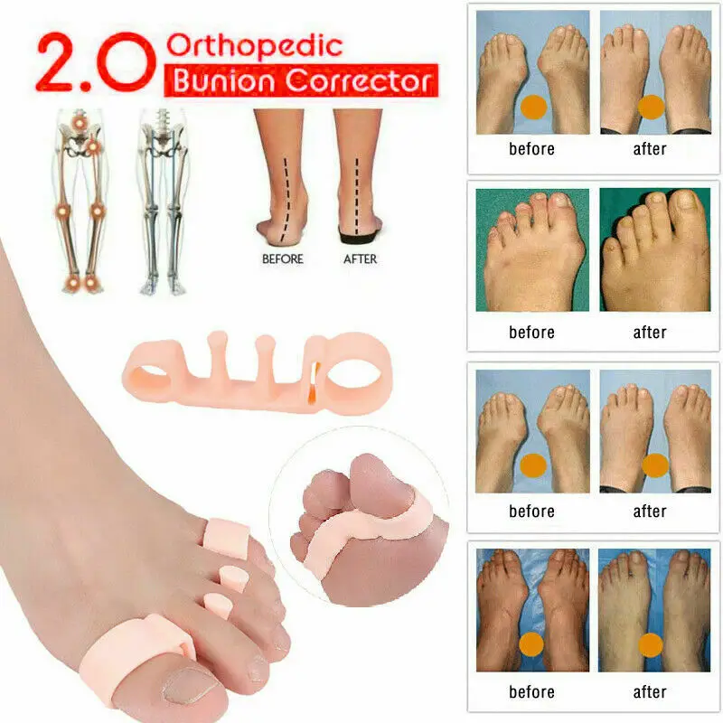 

1Pair Gel Toe Corrector 2Pcs Toes Separators Stretchers Orthotics Hammer Orthopedic Cushion Protector Thumb Calgus Protector Hot