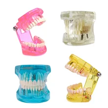 Красочные 1 шт. зубной имплантат болезни зубов Модель с восстановление мост зубной Стоматолог для спецодежда медицинская наука Уча