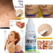 Лечение китайской медициной удаления кожных бородавок удаление кукурузы для ног растительные бородавки Pomada De Verruga уход за кожей медицинская мазь