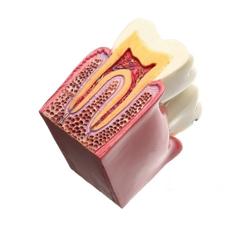 Новый 1 шт. 6x протезов зубов Модель кариеса сравнение модели кариеса модель Стоматолог патологии для Медицинские товары преподавания