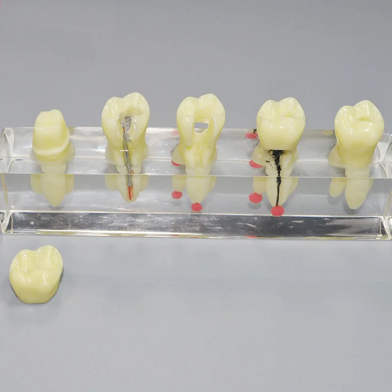 1 шт. Стоматологическая оральная Эндо корневого канала лечение зубов Модель для обучения коммуникации M-4012