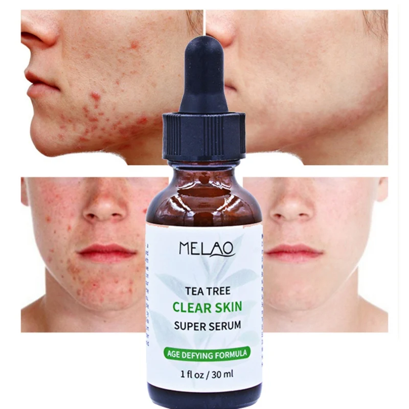 

Tea Tree Essential Liquid Oil-Control Smooth Scars Acne Marks Moisturizing Face Serum Hot