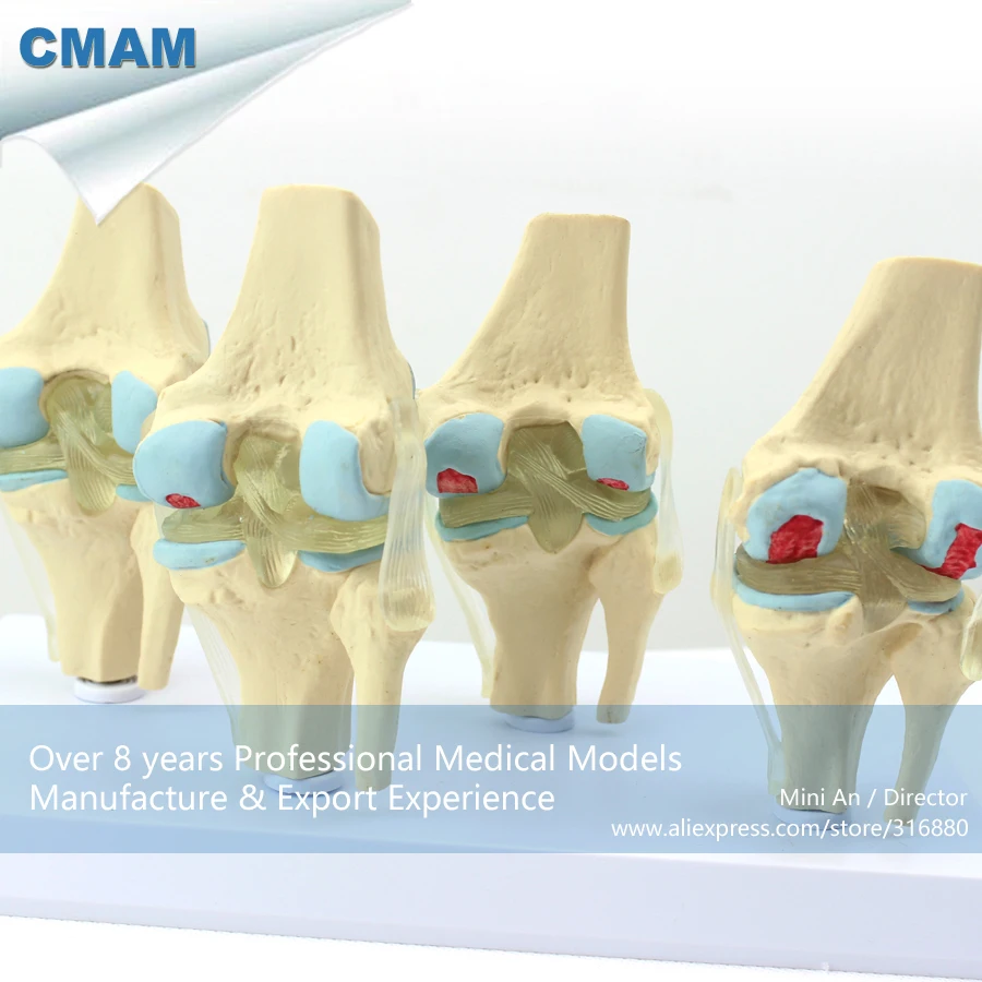 12359/человека 4-х ступенчатый остеоартрит колена комплект совместное Исследование модели, медицинские товары образования анатомические модели