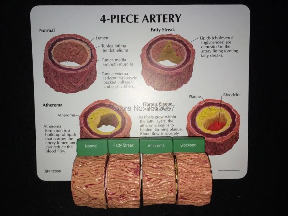 Blood Vessel Model Hardening of The Arteries Show For Process to Atherosclerosis model Thrombotic lesion mo | Канцтовары для офиса