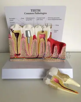 

teeth common pathologies model removable dental model teaching equipment