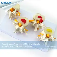 CMAM-VERTEBRA12 Life-size Lumbar Vertebrae Models in 3 Stages of Degeneration