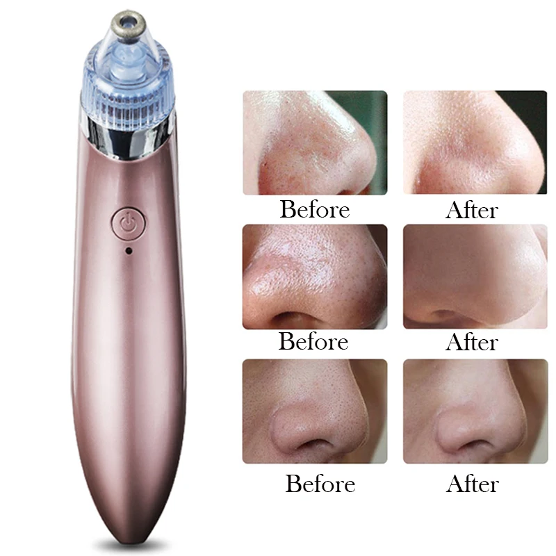 Electric Facial Suck Machine Blackhead Utilizes Pore Vacuum Remover