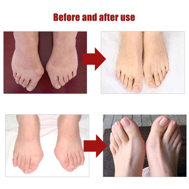 1Pair Braces Foot Care Toe Braces Silicone Toe Separator Hallux Valgus Orthopedic Corrector Pedicure Tools Health Care Products